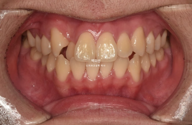 유학생 교정 덧니 반대교합 인비절라인 라이트 치료기간 관련 이미지 2