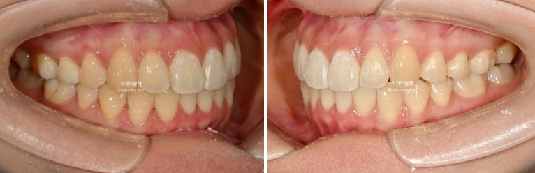 인비절라인 비발치 토끼이빨 교정 덧니 교정 치료기간 1년 8개월 관련 이미지 11