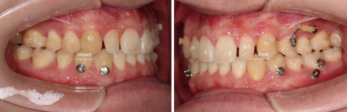 비대칭 비발치 거미스마일 잇몸미소 중심선 가위교합치료 무삭제 라미네이트 관련 이미지 15