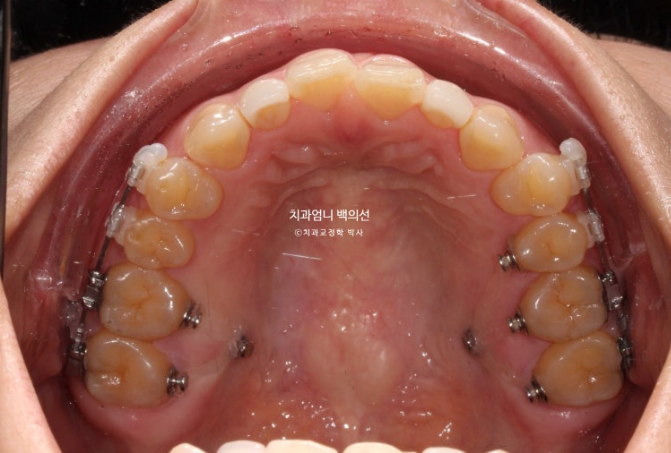 비수술 개방교합 클리피씨 30대 무삭제 라미네이트 치료기간 2년 관련 이미지 6