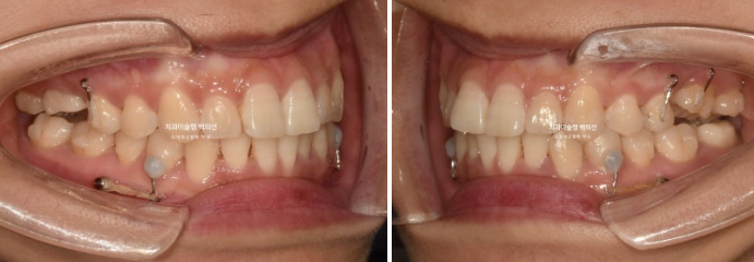 인비절라인 돌출입 발치교정 임플란트 없이 사랑니 대체 관련 이미지 12