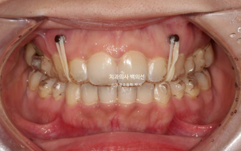 인비절라인 라이트 재교정 발치공간 벌어짐 ? 관련 이미지 4
