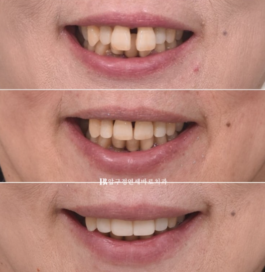 A 60s Patient’s Orthodontic Treatment Review | A Case Combining Partial Orthodontics for the Front Teeth After Periodontitis Treatment with No-Prep Veneers image 11