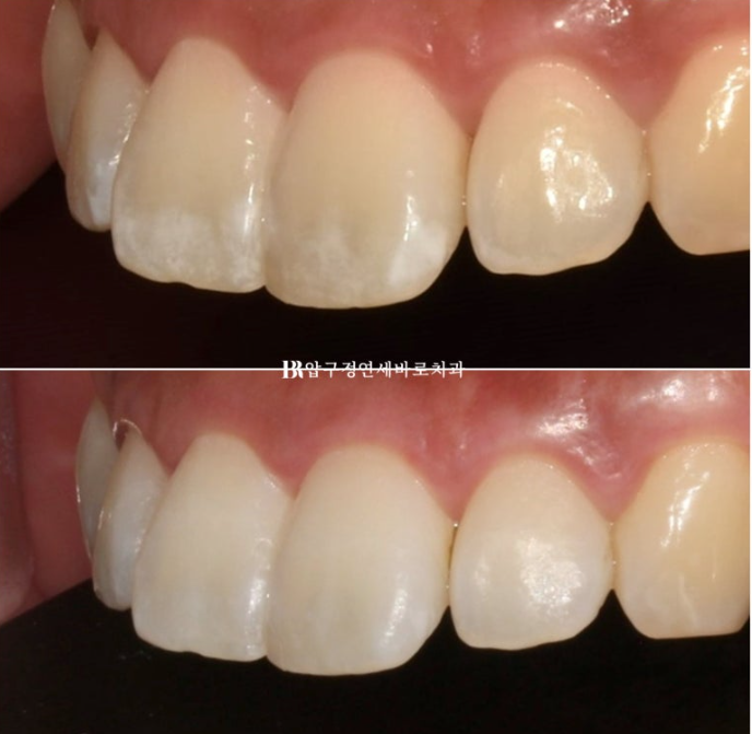 치아 흰 반점, 갈지 않고 치료할 수 있을까요? 아이콘(Resin Infiltration) 실제 사례 관련 이미지 2