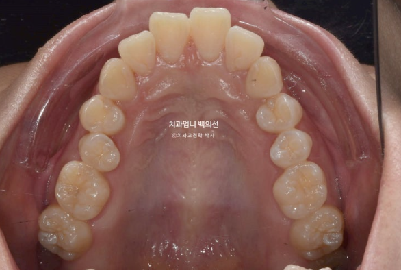 돌출입 교정 인비절라인 발치 교정 후기 관련 이미지 5