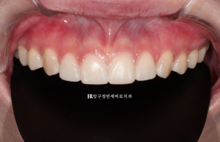 왜소치·원추형 치아, 교정 대신 무삭제 라미네이트로 개선한 사례 관련 이미지 6