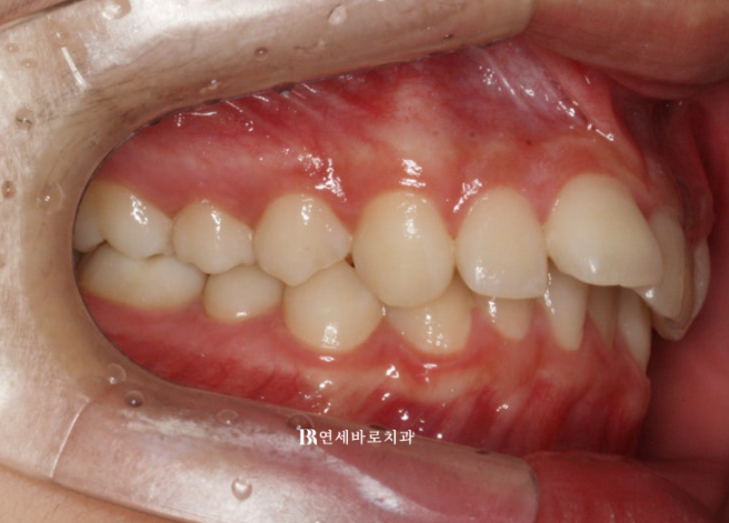 인비절라인 비추천 하는 경우? 관련 이미지 1