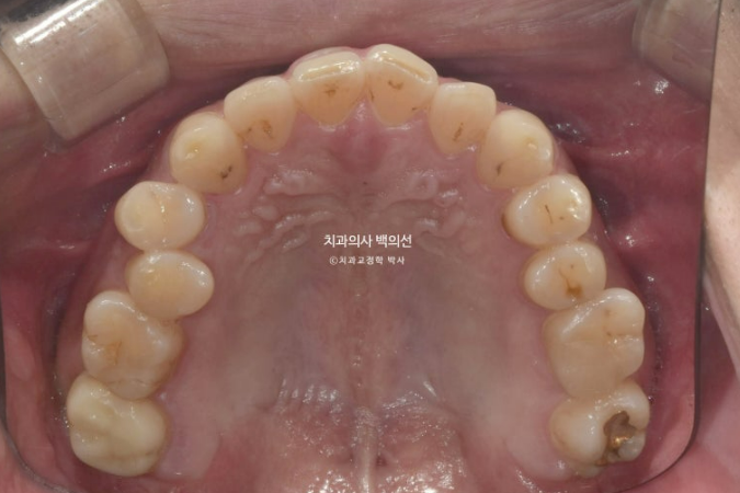 30대 주걱턱 비수술 비발치 교정 후기 관련 이미지 4