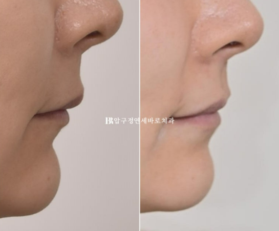 임플란트가 있어도 교정이 가능할까요? 캔팅 재교정 실제 사례 관련 이미지 17