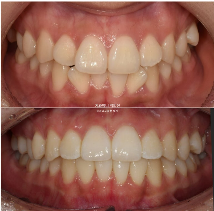 앞니 부분 교정 토끼이빨 덧니교정 ? 관련 이미지 13