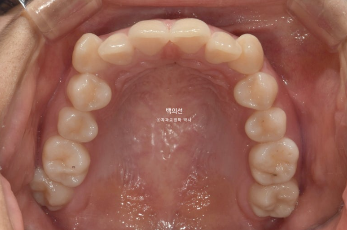 덧니 발치교정 클리피씨 입매 부작용 인중 입술 잇몸 퇴축 관련 이미지 5