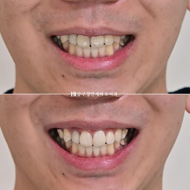 Icon White Spots on Teeth: Resin Treatment for White Spot Lesions image 10