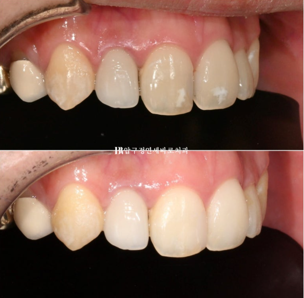 Icon White Spots on Teeth: Resin Treatment for White Spot Lesions image 8