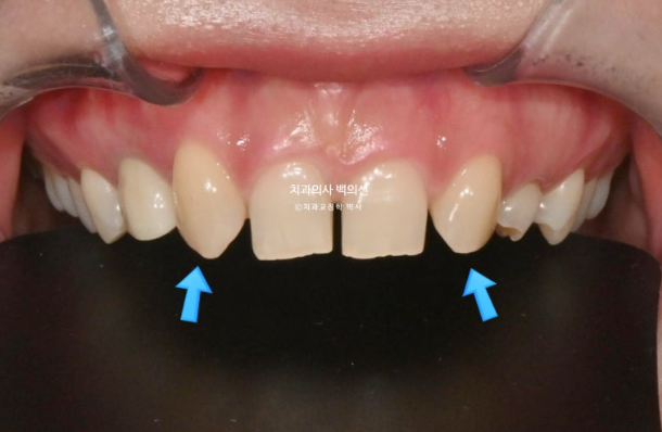 앞니 선천적 결손 벌어짐 잔존 유치 무삭제 라미네이트 관련 이미지 3