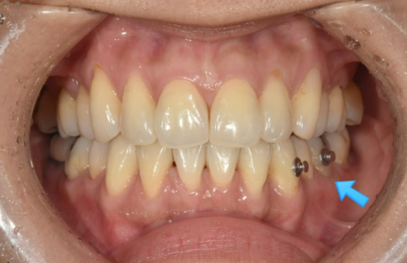 블랙트라이앵글 없애는 교정 가능할까요? 재교정 단기교정 후기 관련 이미지 5