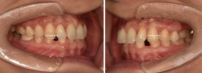 해외거주 앞니 선천적 결손 과개교합 인비절라인 라이트 브릿지 치료 관련 이미지 3
