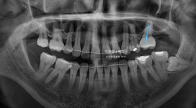 옥니 역교정 재교정 무턱 교정 치료기간 1년 10개월 관련 이미지 5