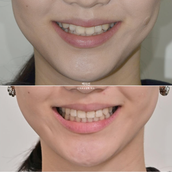 비발치 덧니교정 인비절라인 교정 사랑니 이용 교정 관련 이미지 20