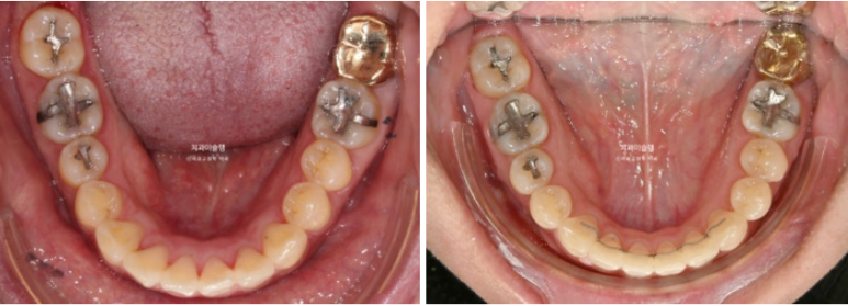 Extraction Orthodontics with Clippy-C for Protruding Mouth, Gum Smile, Gummy Smile Correction, and Treatment for a Recessed Chin image 13