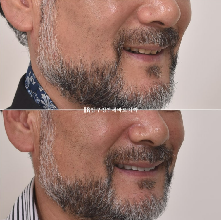 50대 중년교정 무삭제 라미네이트 중년 부분교정 후기 관련 이미지 11