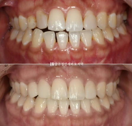 왜소치 치료 잔존유치 무삭제 라미네이트 후기 관련 이미지 12