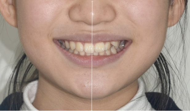 덧니 돌출입 발치교정 상악만 2개 편악 발치 클리피씨 입술부전증 치료 관련 이미지 3