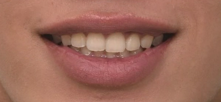 압구정 인비절라인 라이트 과개교합 후기 관련 이미지 3