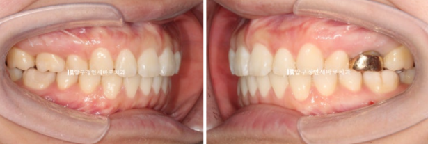 Gummy Smile Correction Review | Natural Improvement of Gummy Smile and Buccal Corridors Through Extraction Treatment for Protruding Teeth image 9