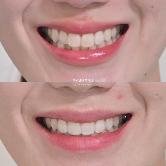 인비절라인 라이트 교정 앞니돌출 과개교합 덧니 교정 관련 이미지 11