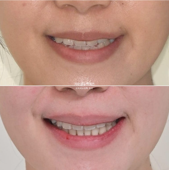 비발치 교정 덧니 인비절라인 교정 절단교합 반대교합 치료기간 1년 6개월 관련 이미지 26