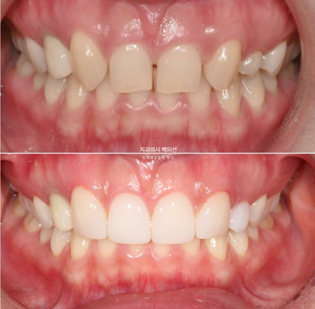 앞니 선천적 결손 벌어짐 잔존 유치 무삭제 라미네이트 관련 이미지 11
