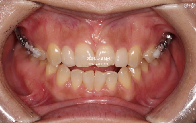 비수술 개방교합 클리피씨 30대 무삭제 라미네이트 치료기간 2년 관련 이미지 5
