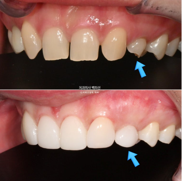 앞니 선천적 결손 벌어짐 잔존 유치 무삭제 라미네이트 관련 이미지 10