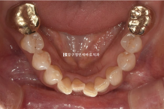 Can It Be Done in Your 50s? Real Results from Limited Front Teeth Orthodontics + No-Prep Laminate Veneers Revealed image 5