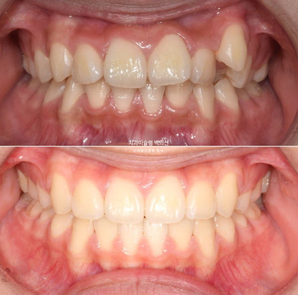 덧니 돌출입 발치교정 상악만 2개 편악 발치 클리피씨 입술부전증 치료 관련 이미지 14