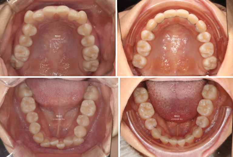 덧니 발치교정 클리피씨 입매 부작용 인중 입술 잇몸 퇴축 관련 이미지 12