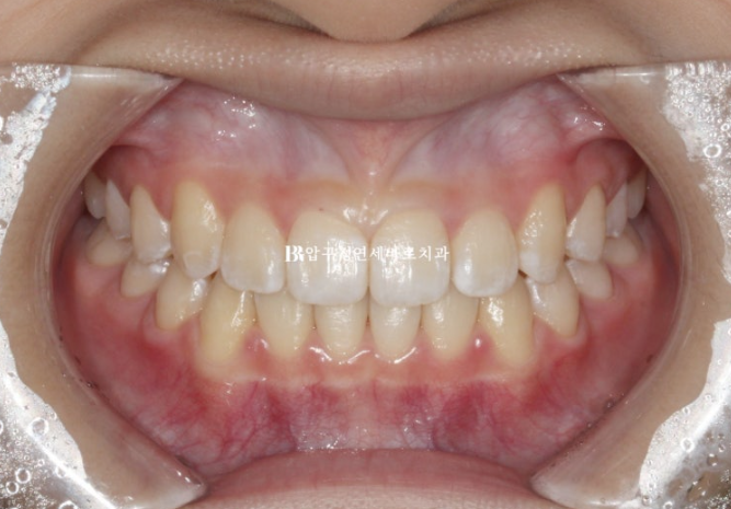 Simultaneous Arch Expansion and Teeth Alignment for Elementary School Children with Invisalign｜Invisalign First image 11