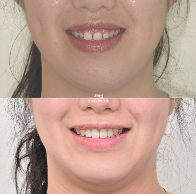 30대 치아교정 돌출입 교정 :: 잇몸미소 거미스마일 교정 입술부전증 결손치 무턱교정 관련 이미지 23