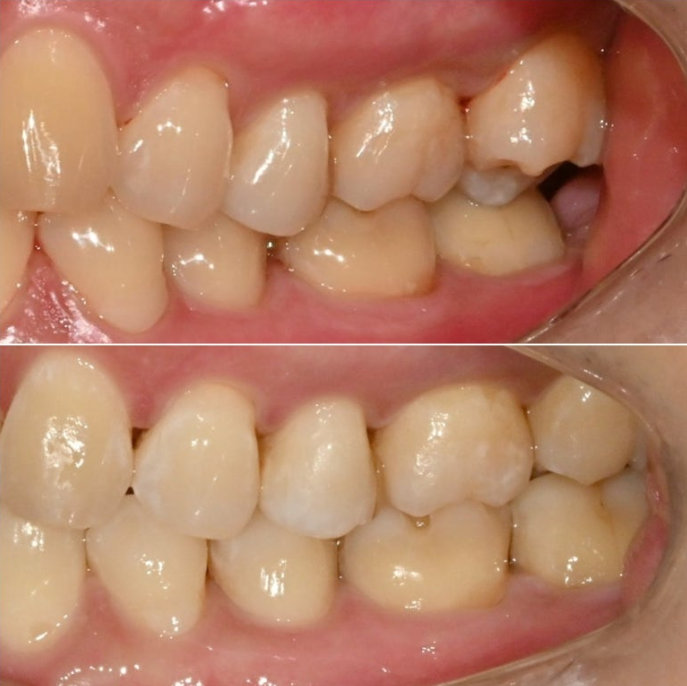 가위교합 벌어짐 중심선 과개교합 인비절라인 라이트 교정 관련 이미지 18