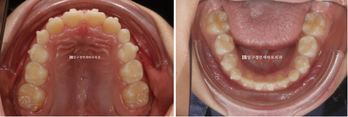 Invisalign First Correction for a Retruded Chin in a Child Orthodontic Treatment for Protrusion image 15