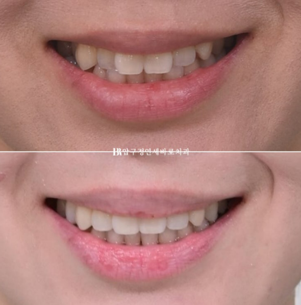 9-Month Invisalign Lite Review|Real Case Improving a Crossbite and Crooked Teeth Together image 11