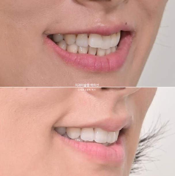 인비절라인 익스프레스 재교정 블랙트라이앵글 치간 삭제 치료기간 6개월 재제작 1회 관련 이미지 18