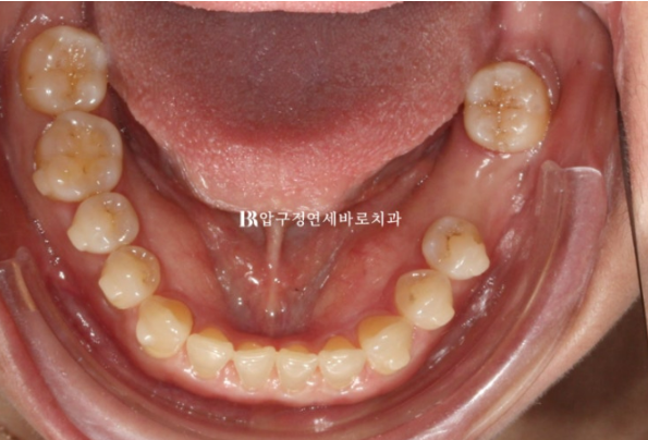Can Gaps Between the Front Teeth Be Treated with No-Prep Veneers Alone? A Real Case Completed with Gelami After Invisalign Lite image 10