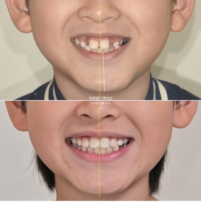 어린이 교정 인비절라인 퍼스트 비대칭 반대교합 어린이 성장 교정 관련 이미지 20