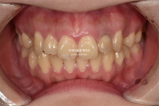 잇몸미소 인비절라인 거미스마일 토끼이빨 교정 무삭제 라미네이트 반대교합 치료 후기 관련 이미지 2