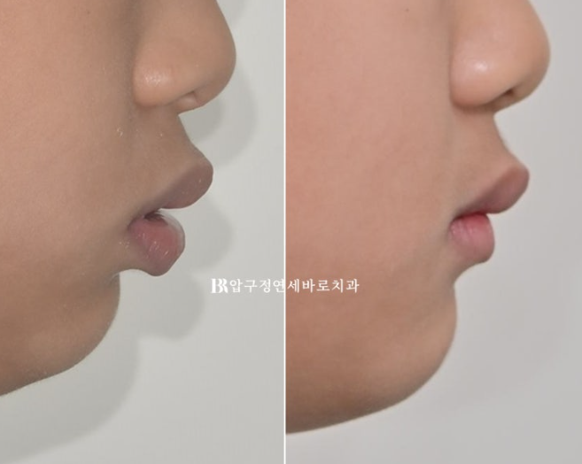 Pediatric Clear Aligners That Improved Both Deep Bite and Protruding Teeth image 20