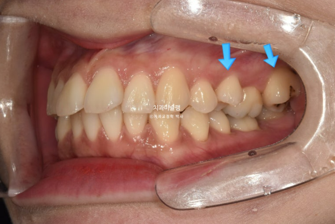 비발치 돌출입 인비절라인 교정 가위교합 중심선 맞추기 관련 이미지 4