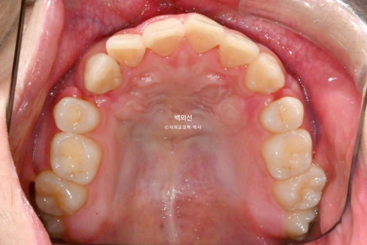 돌출입 수술 ASO + 인비절라인 라이트 후교정 치료기간 10개월 관련 이미지 5