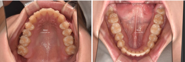 유학생 교정 인비절라인 라이트 치료기간 5개월 관련 이미지 8