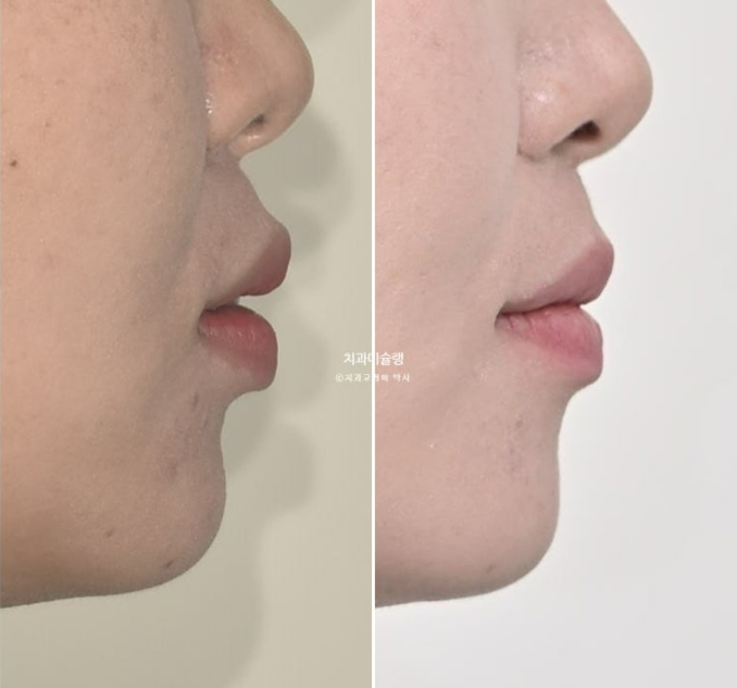 비발치 돌출입 인비절라인 교정 가위교합 중심선 맞추기 관련 이미지 1